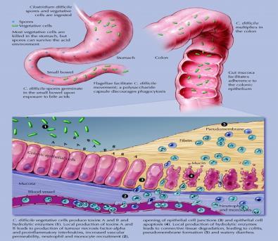 Clostridium difficile Two exotoxins are associated with active disease Toxin A Activates inflammatory cells which release cytokines Causes increased mucosal permeability and loss of fluids Toxin B