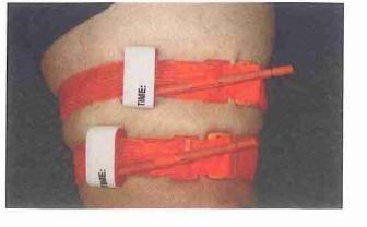 Tourniquets may be used early on if the rescuer determines that the bleeding cannot be controlled with other measures.