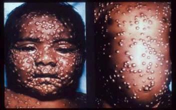 Smallpox Variola virus, Orthopoxvirus Eradicated from the world in 1977 Narrow host range: