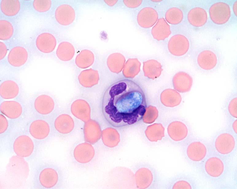 Figure 1. Day 1 blood smear: Neutrophil containing a H.