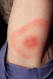 called erythema migrans Occurs in about 70-80% of infected persons Begins at the site of bite after