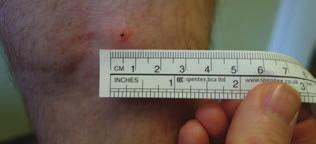 Briefing Note Courtesy of J. Douglas. Figure 3 Tick attached to a person s leg and being removed using a tick removal device. and Wales in 2008).
