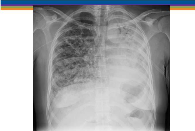 38 year old woman admitted in respiratory failure along U.S.