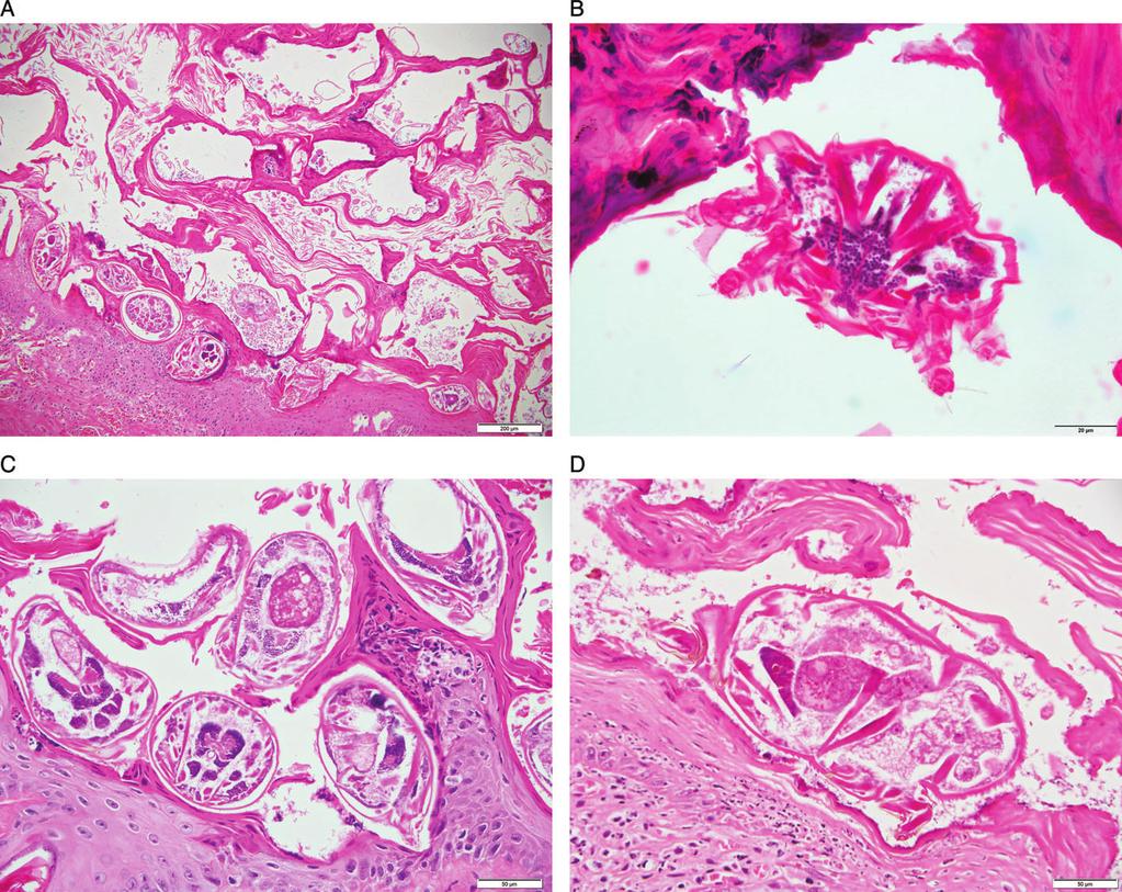 Figure 4. Histopathology of skin from two Victorian koalas affected by sarcoptic mange (H&E).