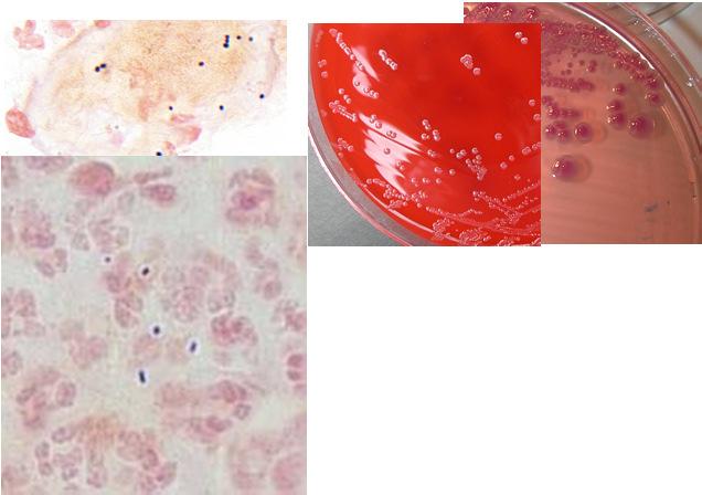 (children) may be hemolytic Endocarditis (adults) Streptococcus anginosus group (S.
