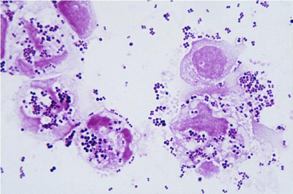 Gram-positive Staphylococcus aureus Cocci clusters Streptococci Cocci chains Streptococcus pneumoniae Cocci (lancet), duplo,