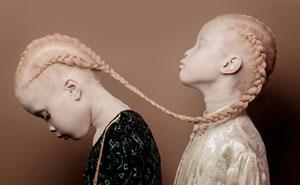 The Best Response Ever Albino Twins From Brazil