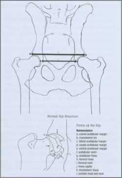 Normal Hip Structure and Nomenclature Stresses on the Femoral Head HIP DYSPLASIA its definition and structural components.