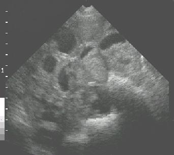 Foetal
