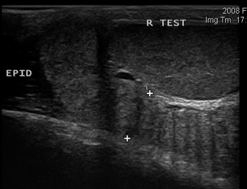 1216 Makloski Fig. 8. Testicular ultrasound revealing epididymitis.