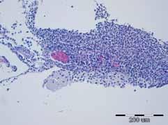 Na jetri po kapsuli i duboko u parenhimu su također bila vidljiva slična multipla gusto rasijana sivkasto bjeličasta žarišta promjera od 1-4 mm (Sl.1. i Sl. 2.).