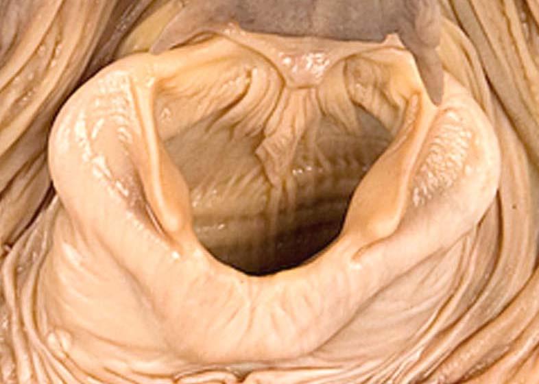 glottis, the prominent mucosal folds (arrows)