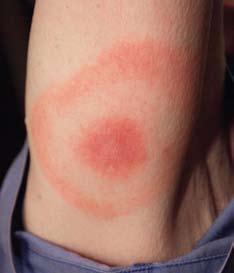 Lyme Disease and Ticks What is Lyme Disease? Lyme disease is an illness caused by bacteria that are transmitted to people by the bite of an infected tick.