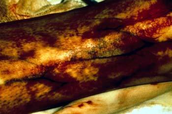 Fourth Degree Burns Prone to infection because of the extensive tissue damage Are exposed to environment contamination