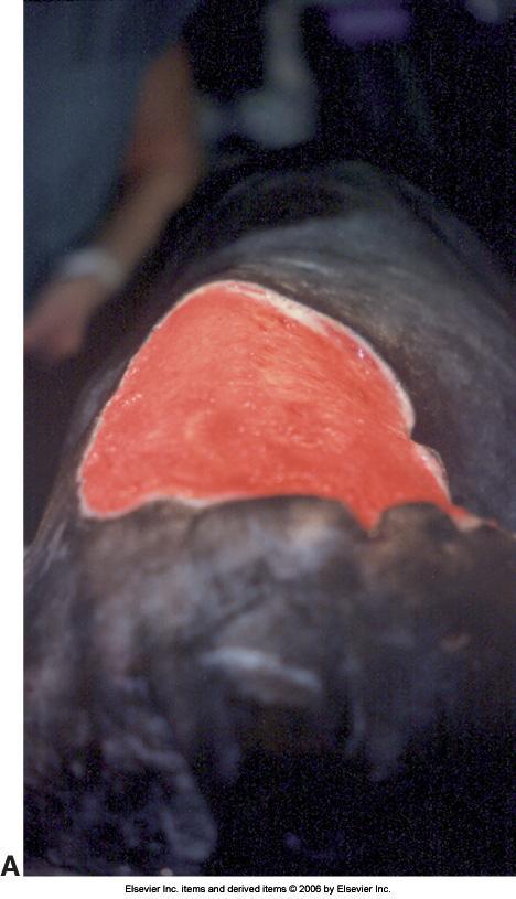 A healthy granulation tissue wound bed on the dorsum of a dog after open wound management of