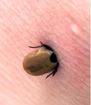 If Bitten by a Tick Disease prevention How long was the tick feeding?