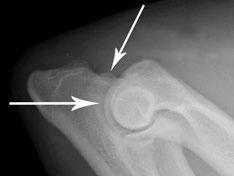 ELBOW DYSPLASIA DATABASE E lbow dysplasia was originally described as a developmental disease manifested as degenerative joint disease (DJD) with or without an ununited anconeal process (UAP).