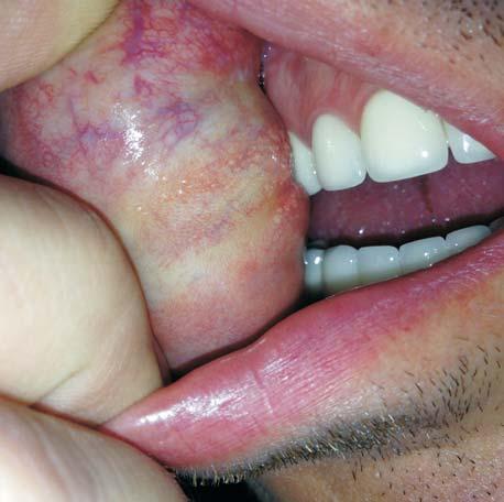Granule alb gãlbui pe mucoasa buzei superioare Fig. 3. White to yellowish on the superior lip mucosa Fig. 4.