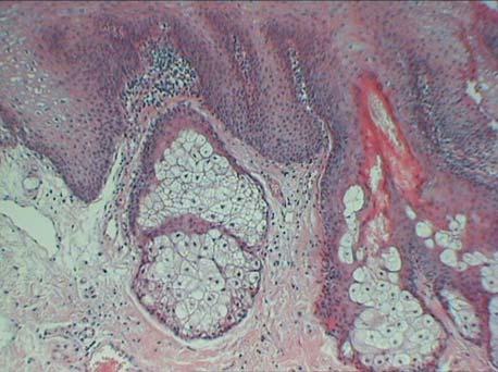 Fig. 5. Detaliu glandã sebacee cu duct înfundat. 10X, HE Fig. 5. Detail, gland with blocked canal. 10X, HE de 2-3 cm 2. În zona genitalã nu s-au evidenþiat leziuni.