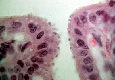 Pathogenesis Intestinal cryptosporidiosis Enterocytes of the distal small intestine-ileum C.