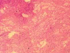 Uz nekrozu epitela u bronhima, submukozalno se vide nekroza mukoznih žlijezda i limfocitarna infiltracija.