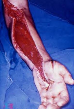 FASCIOTOMY True compartment syndrome is rare Do not allow
