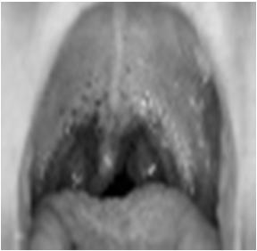 Uncomplicated Gonococcal Infections of the Cervix, Urethra, and Rectum Option 2 Azithromycin 2 g orally in a single dose if ceftriaxone cannot be given because of severe allergy Return 1 week after