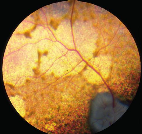 51: Cocker Spaniel retinal pigment epithelial dystrophy, other eye of the same dog (as 50) photographed in blue light.