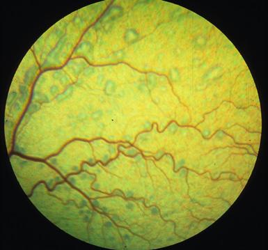 all possible manifestations of multifocal retinal dysplasia, whereas total retinal dysplasia is most commonly associated with nonattachment or complete detachment of the retina.