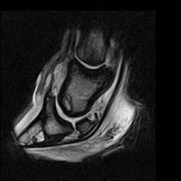 MRI Identify lesions