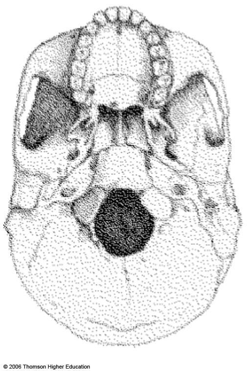 Hole close to center of base of skull; the