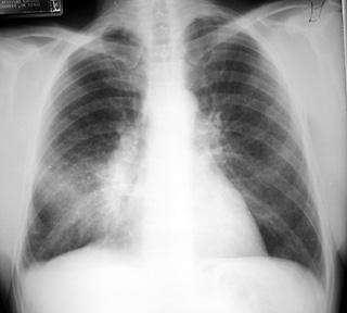 Chest Radiograph Gold Standard All expert guidelines state should have positive CXR to make diagnosis History & exam not good enough (50% sensitive) In outpt setting, should see an infiltrate.