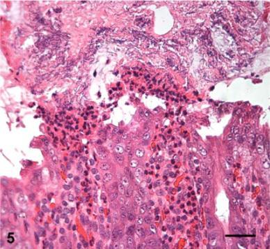 C. difficile: Pigs Release of neutrophils into the lumen: volcano lesion in colon; neonatal pig with C. difficile-associated disease.