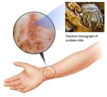 mite Severe pruritus, crusts and alopecia (ears, head and neck) Mites found easily on skin