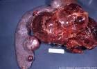 Hemangiosarcoma # Even with surgical removal, the mean life expectancy is