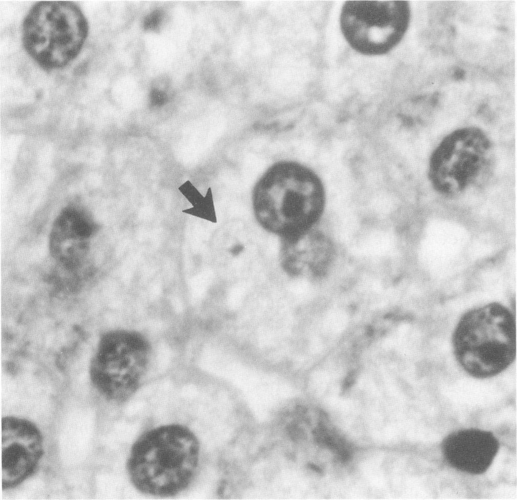 Magnification, x 1,260. Reprinted from Progress in Clinical Parasitology (44) with permission of the publisher. FIG. 5. Hypnozoite of P.