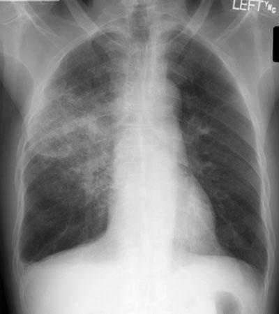 Results Chest X-ray Group Initial presentation: 39/39 (100%) ordered antibiotics 4 days no improvement: 23/39 (59%) performed additional diagnostic testing 26/39 (67%) started or changed