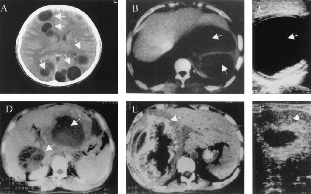 20 ZHANG ET AL. CLIN. MICROBIOL. REV. FIG. 2. Clinical images of CE and AE. (A) CT scan of a brain with CE. (B) CT scan of a liver with CE. (C) Sonogram of a liver with CE.
