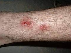 Cutaneous Leishmaniasis Cutaneous Leishmaniasis (CL) is caused by an infection of protozoan parasites of the genus Leishmania.