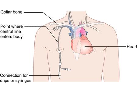 Central Vascular Catheters