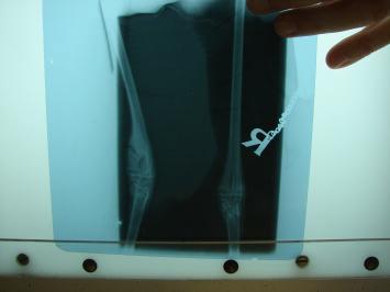 X-Rays showing damage to growth plate and leg after surgery The two remaining chicks continued to grow well and the recommended diet was reduced slightly to ensure growth rates were correct.