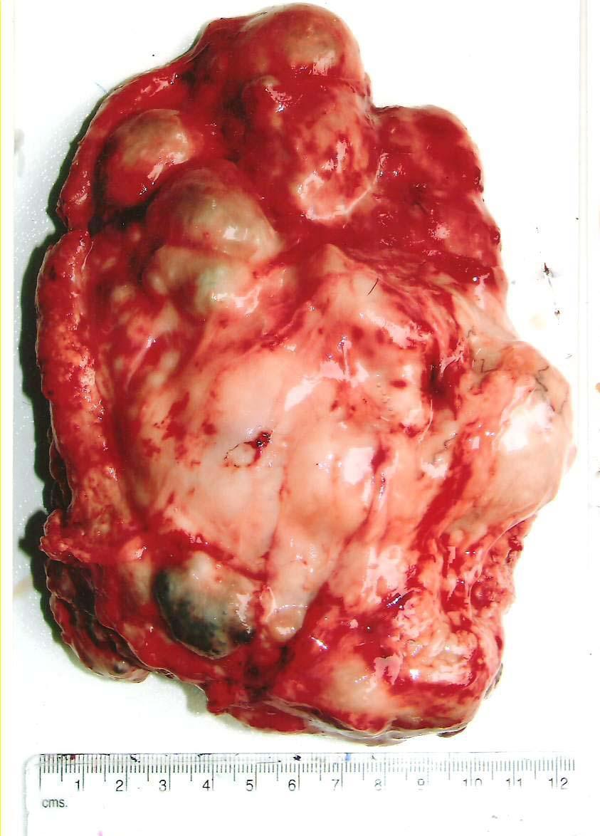 Fig.3 Pendulated masses in a tumor mass after removal Pathological findings The macroscopic examination revealed that the swelling was abnormal, pendulated,