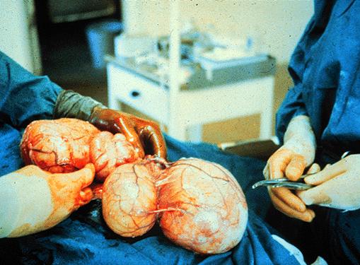 Plate 12. Hydatid cysts removed from the liver of a human. {(University of Pennsylvania.