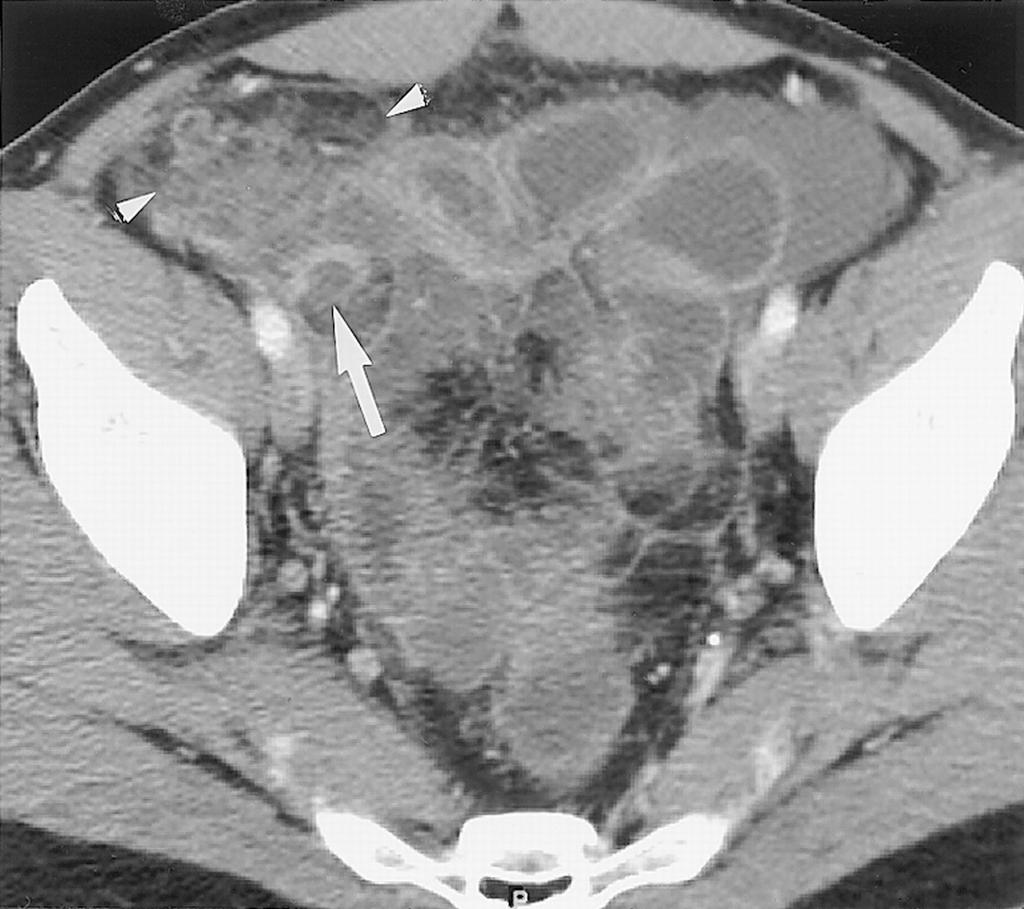 Case 7 Perforated appendix with peritonitis. Axial contrastenhanced CT scan shows enhancement and disruption (arrow) of the appendiceal wall.
