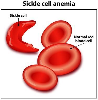 Practice Problem A male and female are both carriers for sickle-cell anemia.