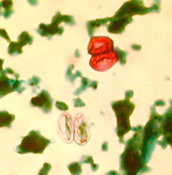 Diagnosis Intestinal sarcocystosis Microscopic observation of oocysts or sporocysts in fecal smear Wet fecal smear- sporulated oocysts Acid fast