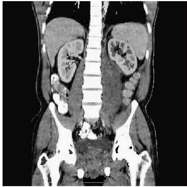 Coronal CT image of psoas abscess