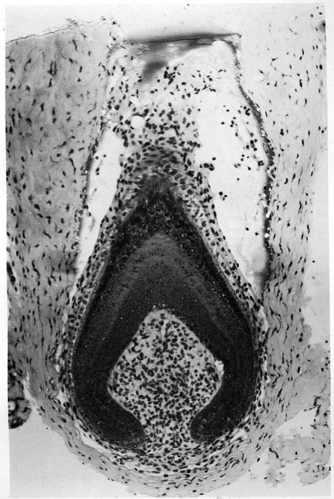 214 L. IBRAHIM AND E. A. WRIGHT Fig. 1. The amputated part of one of the rat's follicles. H & E, x 125. normal-looking dermal papilla present at the bottom of the follicle.