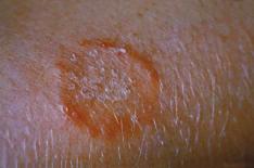 infection caused by a fungus Symptoms include: ring-shaped, crusty patches on the skin where