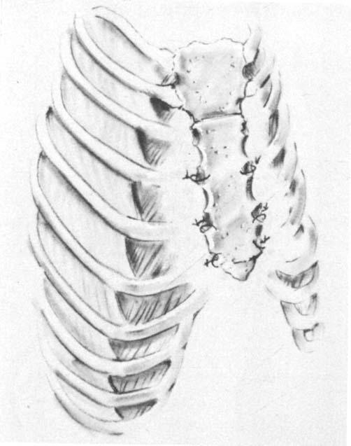 ROBICSEK ET AL. because of the extensive scarring and disappearance of the normal anatomical structure.